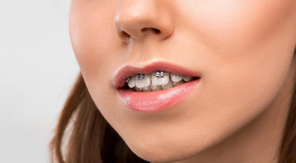 can tongue thrust affect my dental health