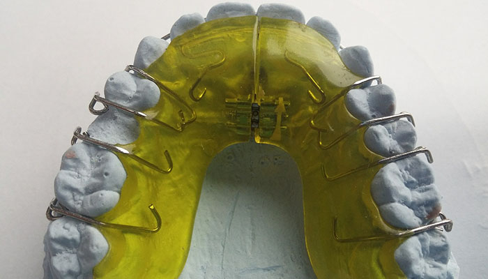 Which Comes First - Braces or Tongue Thrust Therapy?