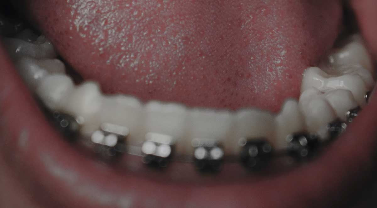 Answering Questions About Braces and Tongue Thrust Therapy