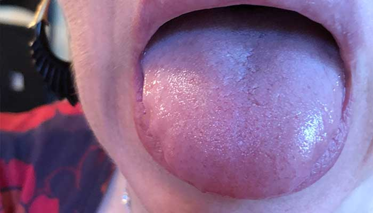 What is the main reason for the fat tongue?